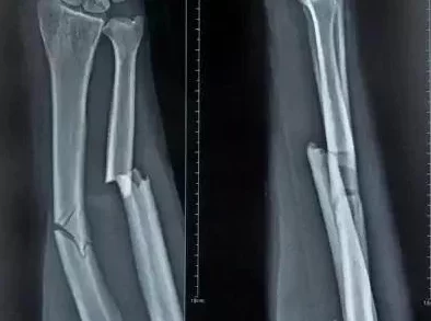 探索父亲康复之路:爸爸活下去的关键策略与痊愈条件全面指南 探索父亲康复之路:爸爸活下去的关键策略与痊愈条件全面指南