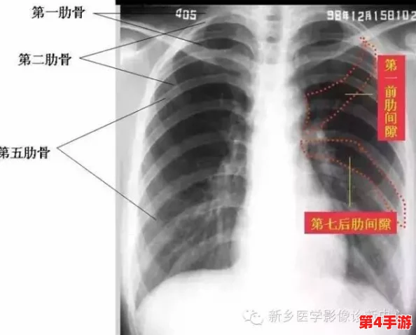 胸片全体曝光：揭示医疗影像背后的隐秘故事与患者健康的真实状况，值得每个人关注和思考